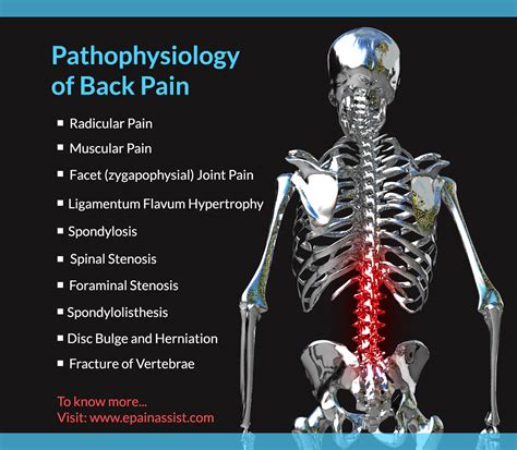 pathophysiology   pain  backacheradicularmuscularfacetreferredprs
