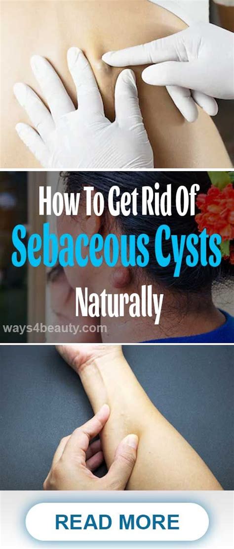 how to get rid of sebaceous cysts naturally ways for beauty in 2020