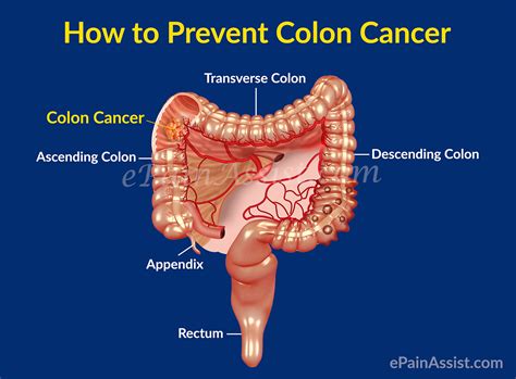 colon cancer  cancer   colonsurvival raterecurrencepreventioncoping