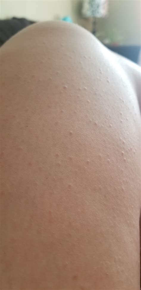 misc ive   bumps   legs   long time  thought    razor burn