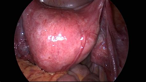 Fibroid Uterus Retroverted Uterus Ventrosuspension 009