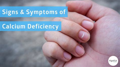 signs symptoms  calcium deficiency youtube
