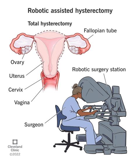 Robotic Assisted Hysterectomy Procedure Risks And Recovery