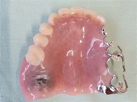 partial dentures plates