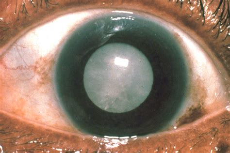 questions  cataract surgery philly