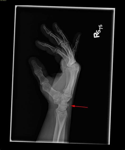 triquetral fracture  rays case studies ctisus ct scanning