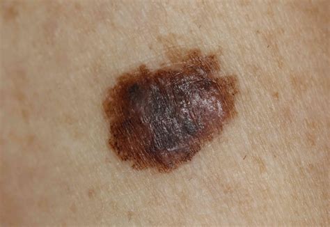 skin cancer signs symptoms  complications