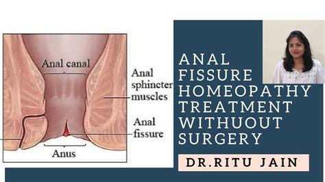 Treatment Care Anal Fissure
