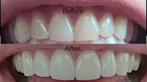 dental veneers procedure overview youtube