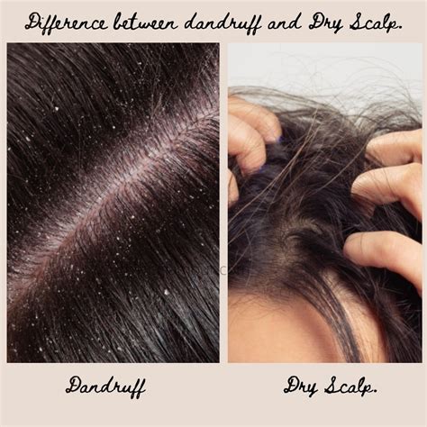dandruff  dry scalp difference symptoms treatment