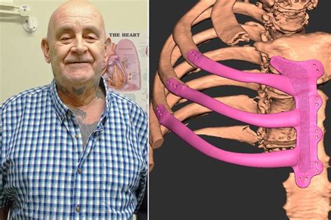 Grandad Receives First 3d Printed Rib Cage In Britain As He Battles