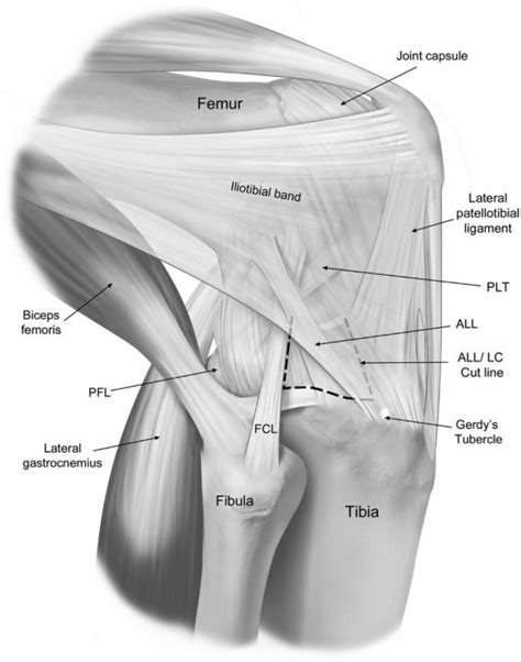 lateral view    knee illustrating  anterolateral corner
