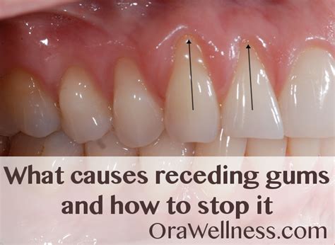 receding gums    stop  orawellness