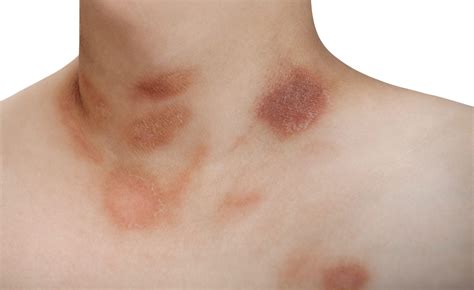 what is pityriasis rosea symptoms and treatment