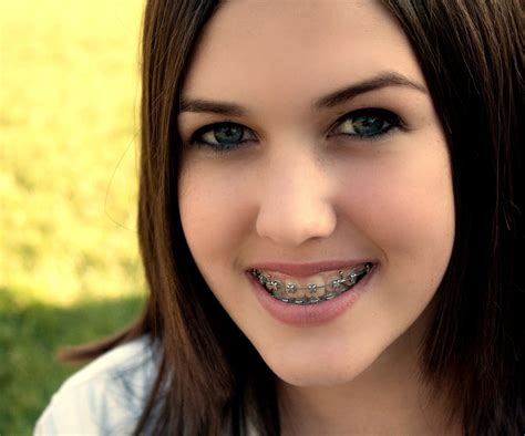 Pin On Beautiful Braces Free Download Nude Photo Gallery