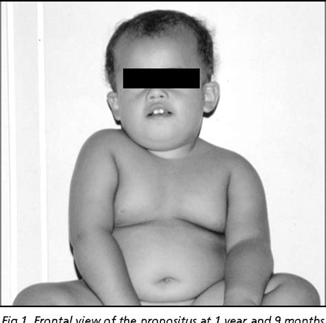 Figure 1 From Atypical Presentation Of Prader Willi Syndrome With