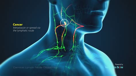 drain  lymph node   neck  drain  primagemorg