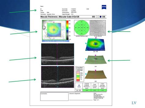 oct tutorial  interpreting cirrus oct macular scans youtube