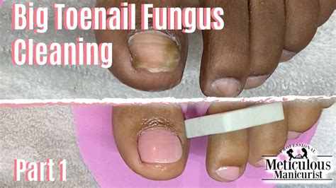 pedicure toenail fungus home remedy cleaning part  youtube