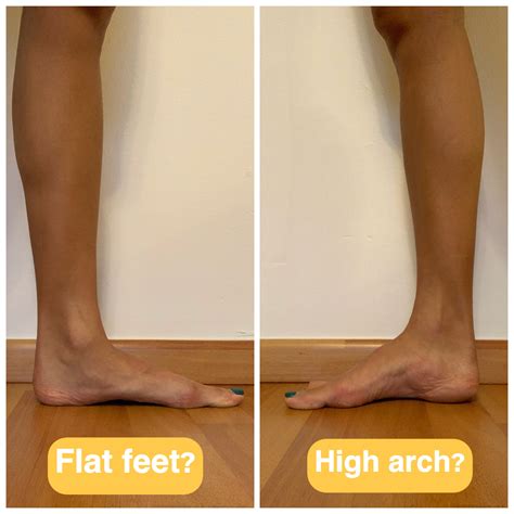 flat feet  high arches