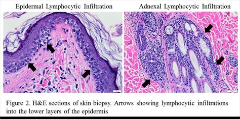 cutaneous epitheliotrophic lymphomamycosis fungoides  dogs clinical