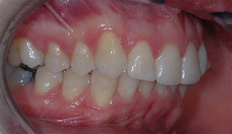 buccal occlusion  alignment dentistrycouk