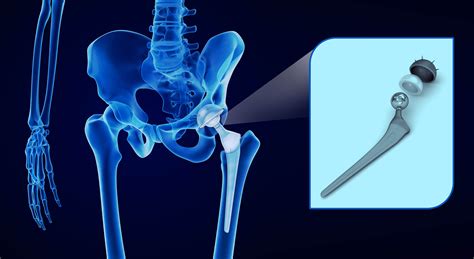 joint replacement texas orthopaedic sports medicine