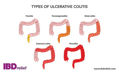 ulcerative colitis uc symptoms treatment