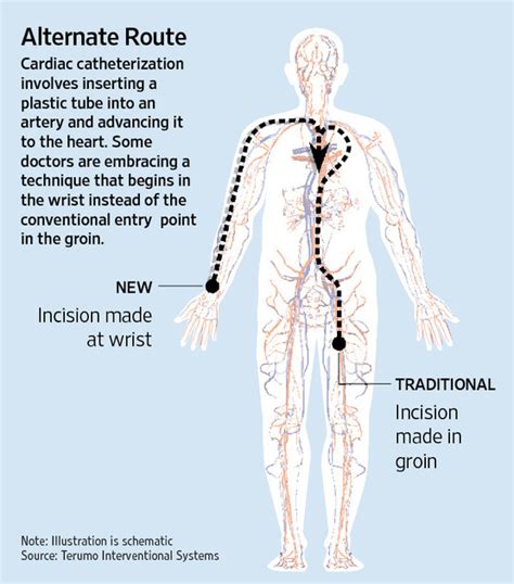 new cardiac catheterization technique may be safer for heart patients wsj