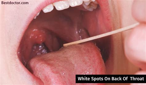 white spots    throat