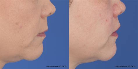 Lip Lift Before And After 06 Weber Facial Plastic Surgery