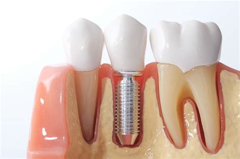 dental implants       single  multi tooth