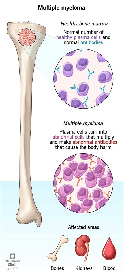 multiple myeloma symptoms    prognosis treatment