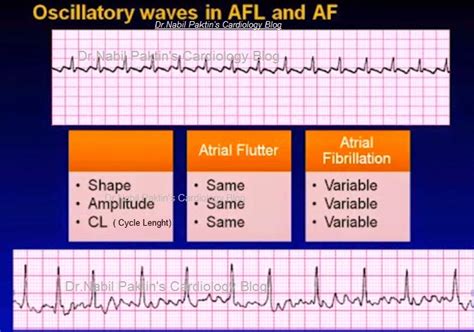atrial flutter vs atrial fibrillation xolergang
