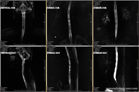 dr balaji anvekar frcr focal adhesive arachnoiditis  spinal cord