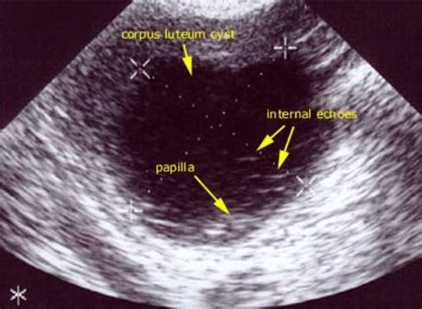 transvaginal ultrasound showing the corpus luteal cyst download