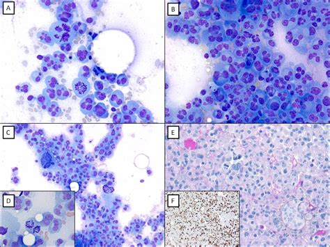 plasma cell myeloma  sarcomatoid morphology
