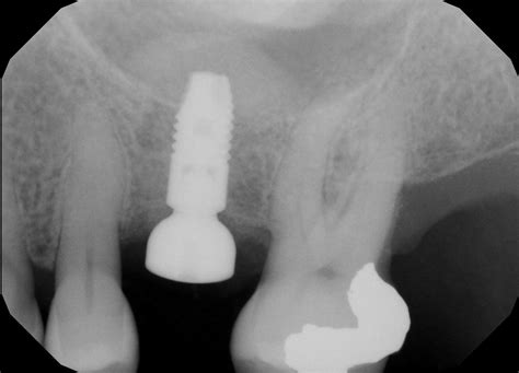 Sinus Elevation Lift Dental Implants And Periodontics Of Ct