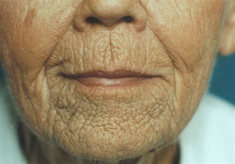 microdermabrasion remove  wrinkles bellatory