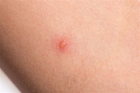 diagnosing skin bumps lumps blisters bug bites