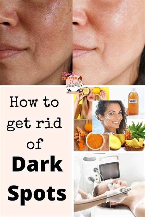 how to get rid of dark spots dark spots on face remove dark spots