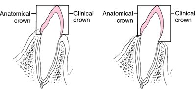 anatomical crown definition  anatomical crown  medical dictionary