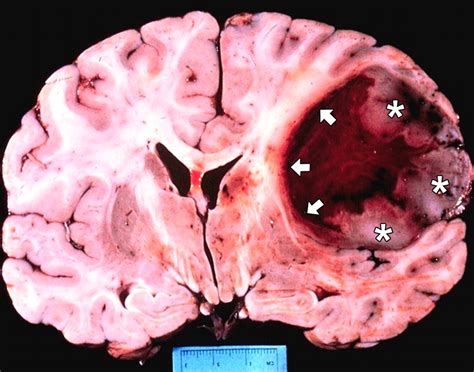 glioblastoma  brain cancer neuro news cosmo clues