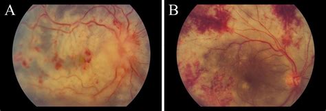 emerging concepts in the management of acute retinal