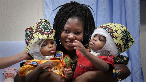 conjoined twin sisters from central african republic successfully