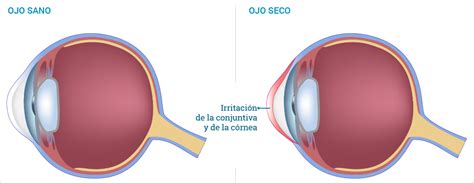 síndrome del ojo seco optogestion