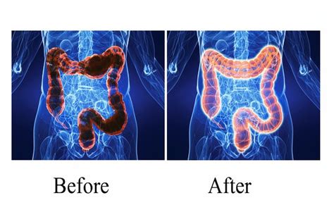 benefits  colon hydrotherapy pristyn care