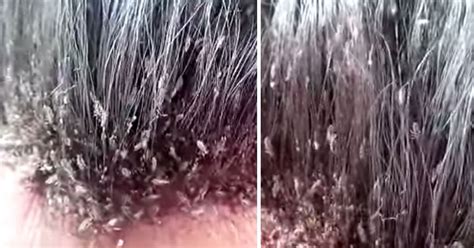 extreme head lice infestation