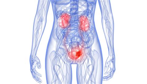 bladder cancer urine test accurate renal and urology news