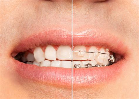 How Invisalign Braces Create The Smile You Have Always Wanted